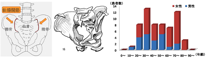 走ると骨盤が痛い　仙腸関節